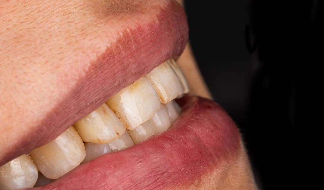 Before - Standard dental work